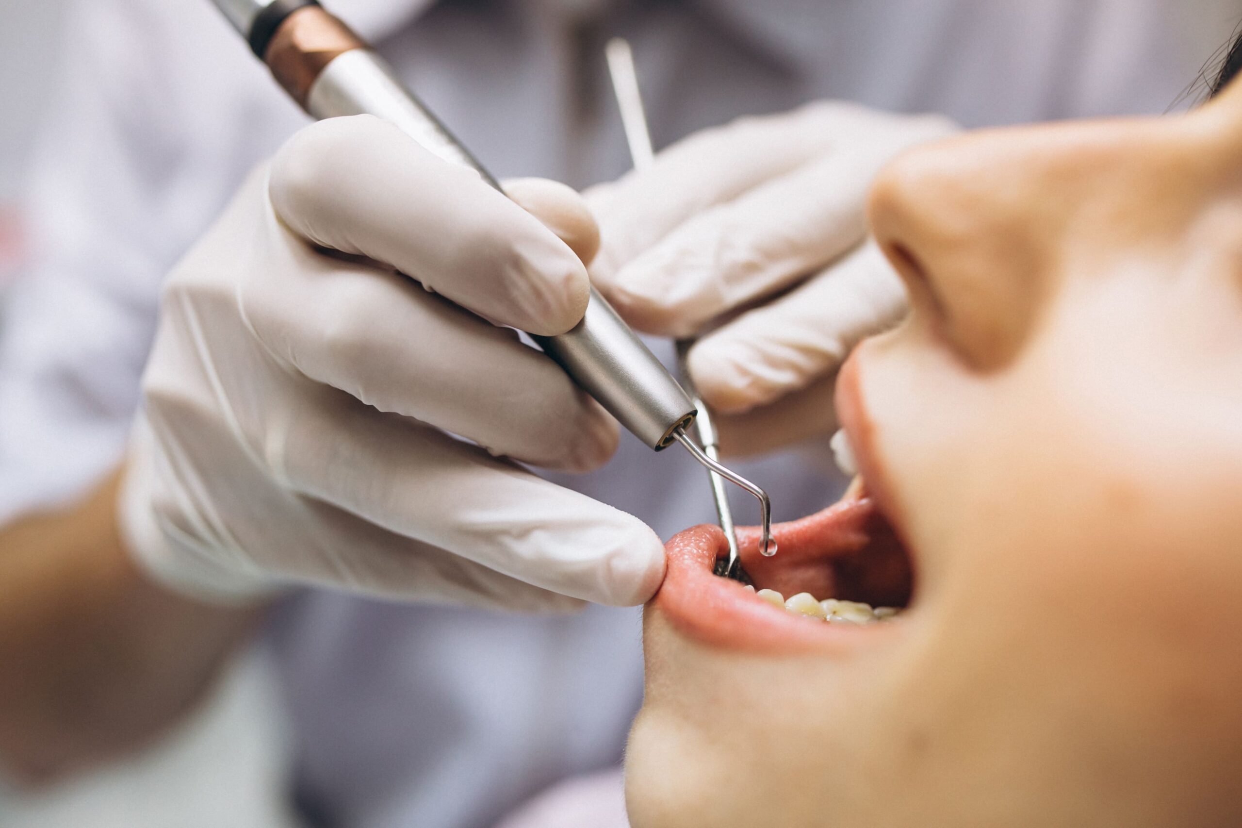 Odontologia Clínica faz limpeza: Saiba mais sobre o procedimento